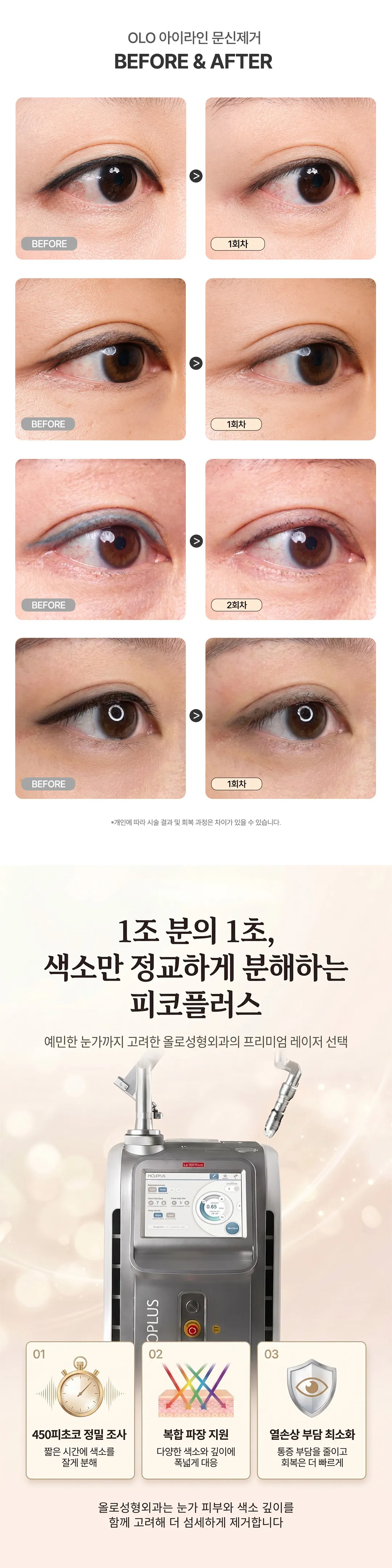 올로성형외과 아이라인 비포애프터 및 피코플러스 레이저
